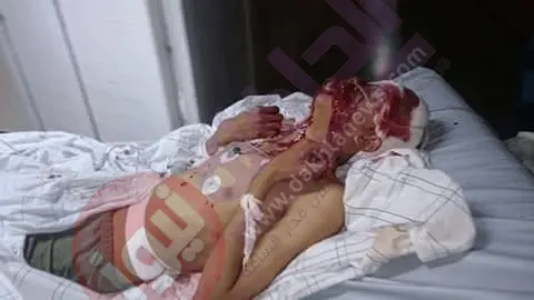 إصابة خمسة أشخاص بجروح متفاوتة الخطورة إثر انفجار “لغم” بالعيون