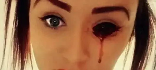 كلما بكت أدمعت دماً.. أغرب مرض في العالم أصيب به 3 أشخاص فقط