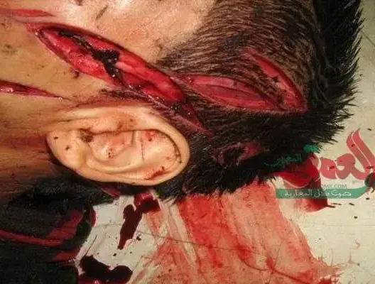 اعتداء شنيع بالأسلحة البيضاء على مواطن بسلا