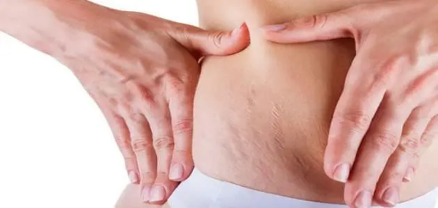 10 نصائح للتخلص من السيلوليت