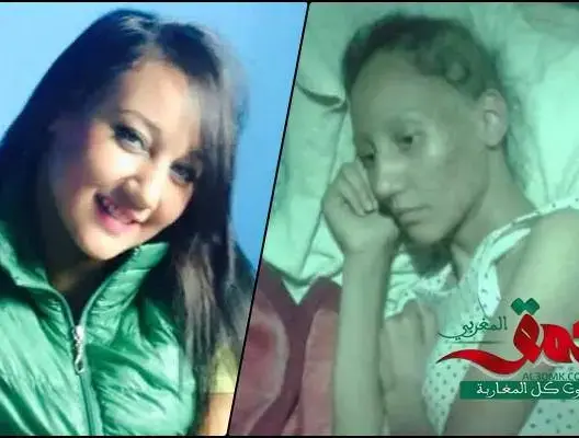 حنان .. فتاة حولها “المرض الخبيث” إلى هيكل عظمي (صور)