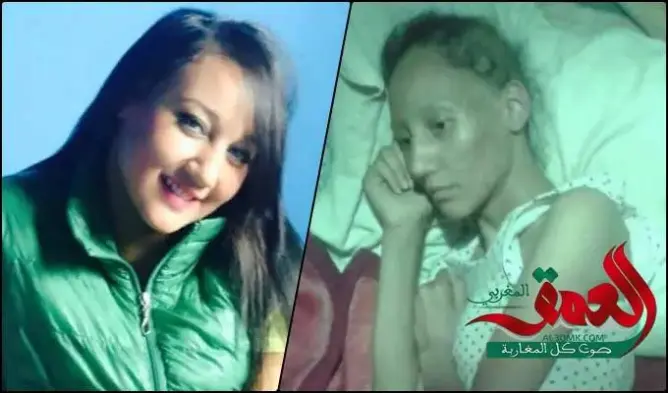 حنان .. فتاة حولها “المرض الخبيث” إلى هيكل عظمي (صور)