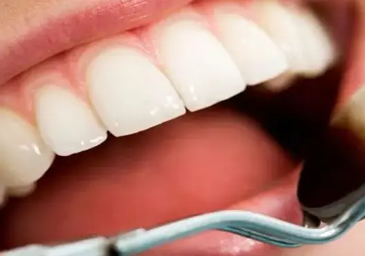 اكتشاف علاج جديد للحد من تلف الأسنان