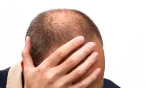 اكتشاف مذهل.. دهون المعدة تقضي على الصلع في 6 شهور