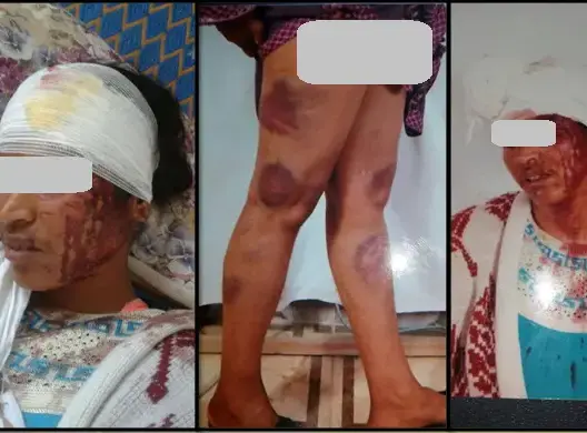 بسبب الإرث.. اعتداء شنيع على امرأة بضواحي القنيطرة