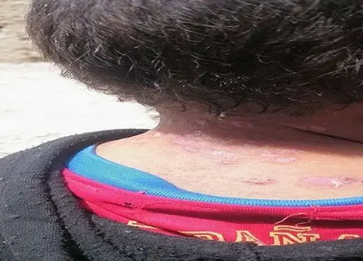 مرض جلدي غريب نواحي ميدلت يثير هلع السكان ومندوب الصحة يوضح