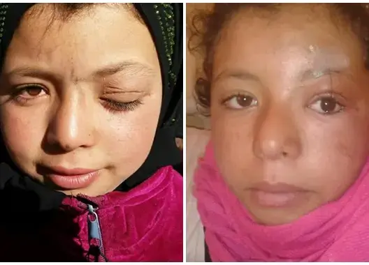 “سرفاتي”.. جراح فرنسي يعيد النور لعين طفلة بقلعة امكونة