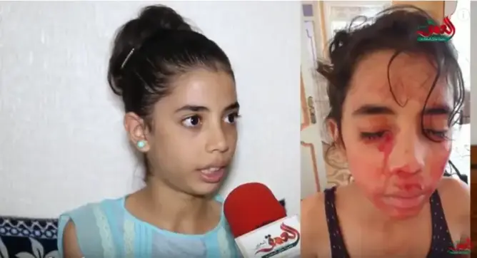 آية المصابة بمرض نادر: حلمي أن أعالج وأصبح طبيبة أسنان (فيديو)