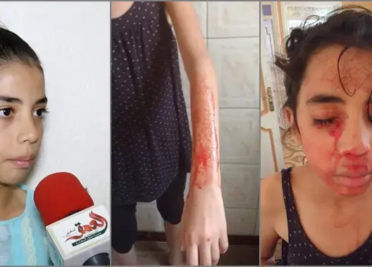 آية .. طفلة تبكي الدمع دما وعائلتها تناشد الملك التدخل لإنقاذها (فيديو)