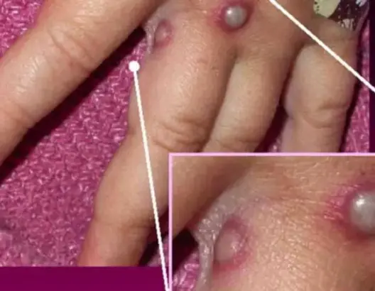 فيروس قاتل يهدد العالم.. وباحثون يسابقون الزمن بحثا عن لقاح