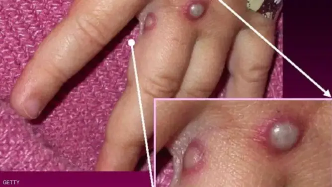 فيروس قاتل يهدد العالم.. وباحثون يسابقون الزمن بحثا عن لقاح