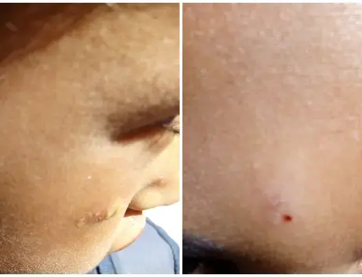 داء “الليشمانيوز” يصيب عشرات التلاميذ بزاكورة.. والصحة توضح