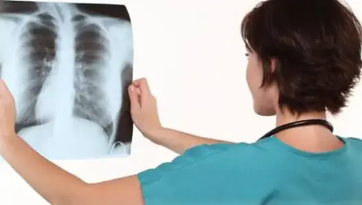36 ألف حالة لداء السل تدفع وزارة الصحة لحملة جديدة