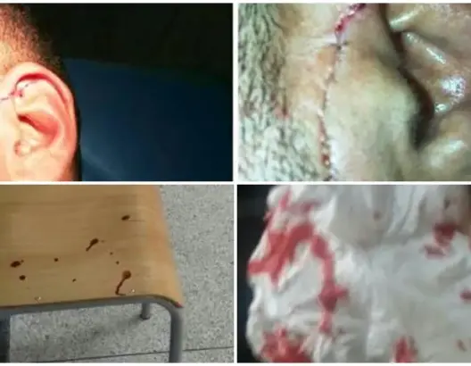بعد ضبطه يغش في الامتحان الموحد.. تلميذ يوجه طعنة غادرة لأستاذ بسلا (صور)