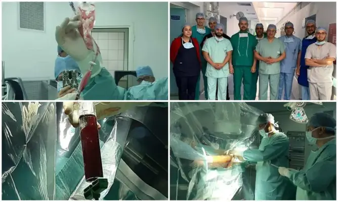 لأول مرة بمراكش.. فريق طبي يجري أول عملية علاج بالخلايا الجذعية (صور)