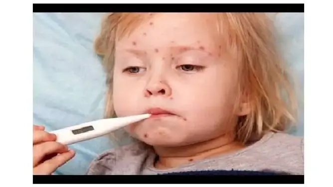 تحذيرات من انتشاره في المغرب.. أخصائي يتحدث عن تفاصيل مرض الحصبة