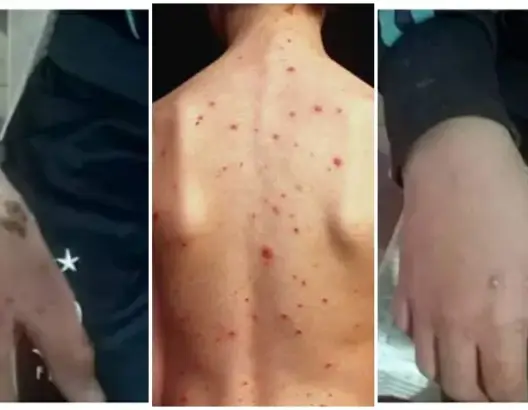 دار للقرآن بجرسيف “تتخلى” عن طالب بسبب مرض “الجرب”