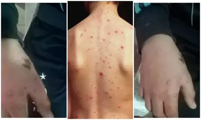 دار للقرآن بجرسيف “تتخلى” عن طالب بسبب مرض “الجرب”