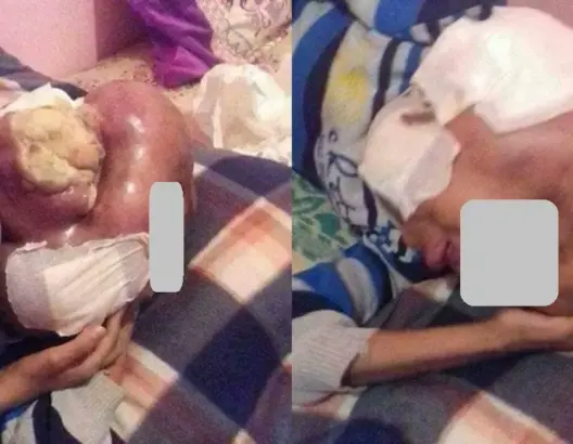 الفقر والسرطان وغياب الرعاية الطبية.. ثالوت يحول حياة طفل لجحيم