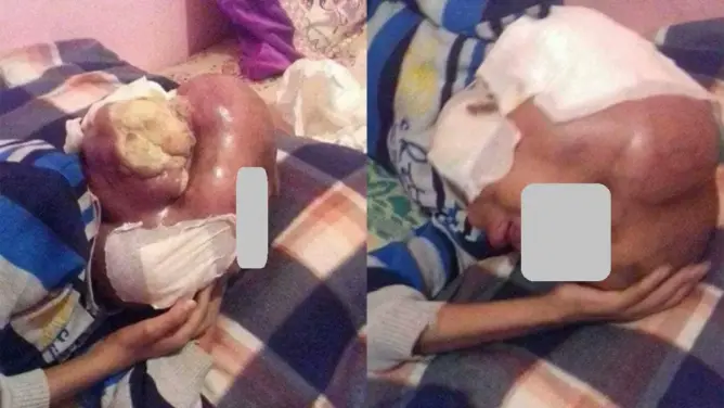 الفقر والسرطان وغياب الرعاية الطبية.. ثالوت يحول حياة طفل لجحيم