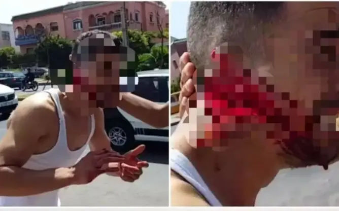 الأمن يتمكن من اعتقال المتورط في “تمزيق” وجه شاب بالبيضاء (صور)