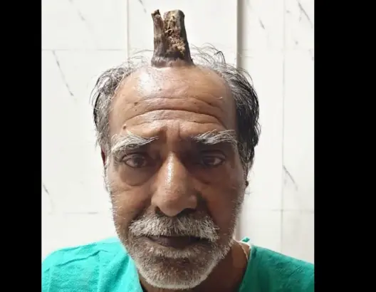 فريق طبي يزيل قرنا طوله 10 سنتم ظَهر برأس فلاح هندي