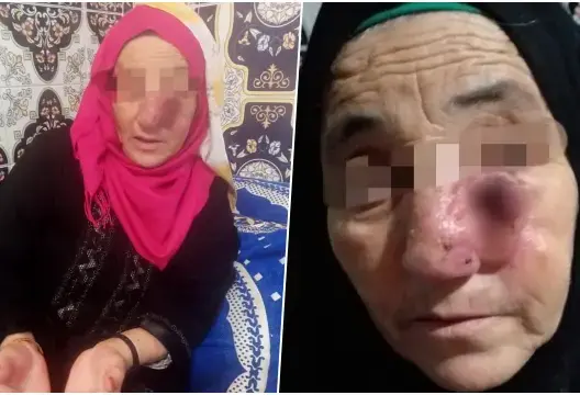 ورم، السرطان، سوس ماسة