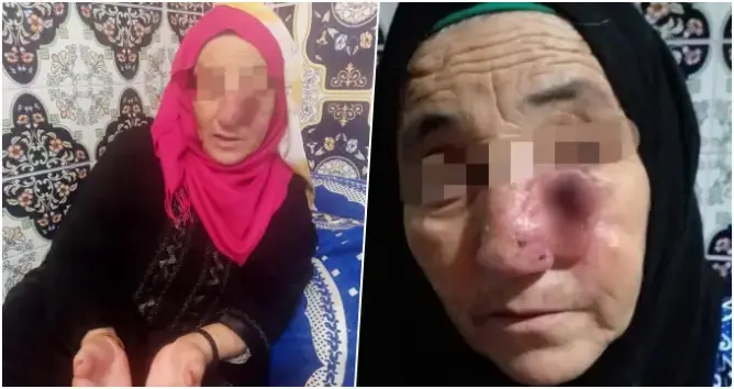 ورم، السرطان، سوس ماسة