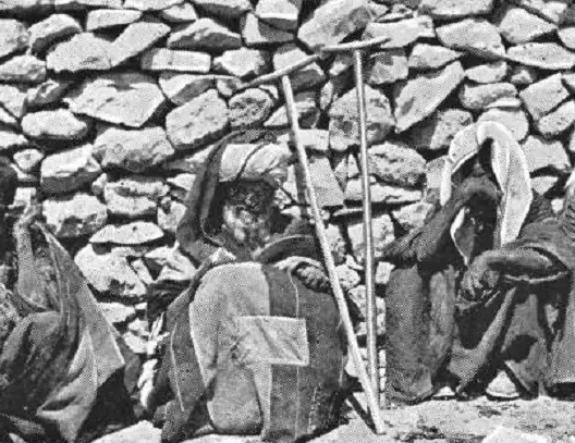 في حارات معزولة .. هكذا نَبذ المغاربة المصابين بالجذام قديما