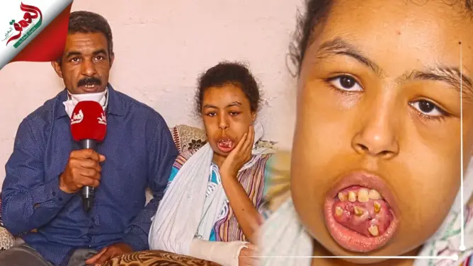 أسنانها تنبت في غير مكانها والأطباء المغاربة عجزوا عن تشخيص حالتها.. وسيمة طفلة من سلا تعيش جحيما
