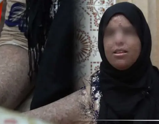 “أطفال القمر”.. سناء تروي لـ”العمق” معاناتها مع الشمس وتشتكي “تجاهل” الدولة (فيديو)