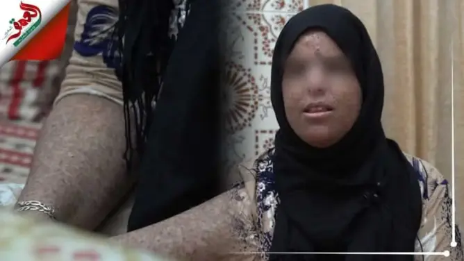 “أطفال القمر”.. سناء تروي لـ”العمق” معاناتها مع الشمس وتشتكي “تجاهل” الدولة (فيديو)