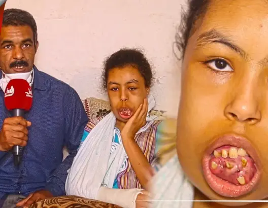 وسيمة.. طفلة بسلا تعيش جحيما بسبب أسنانها والأطباء عجزوا عن علاجها (فيديو)