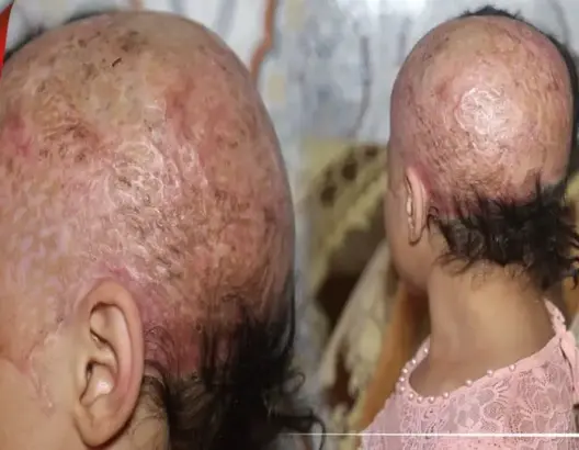 طفلة تعرضت لحادث خطير
