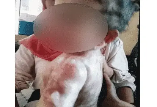 طفلة تتعرض لحروق بتاونات