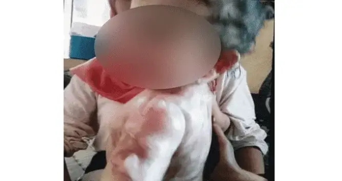 طفلة تتعرض لحروق بتاونات