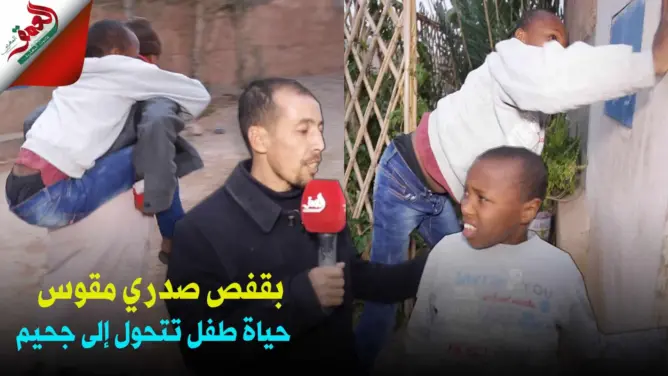 قفص صدري “مُقوَّس” يحول حياة طفل إلى جحيم.. وأسرته تناشد المحسنين (فيديو)