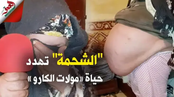 “مولات الديطاي”.. امرأة تعاني من تراكم الشحوم في بطنها توجه نداء للدكتور التازي (فيديو)