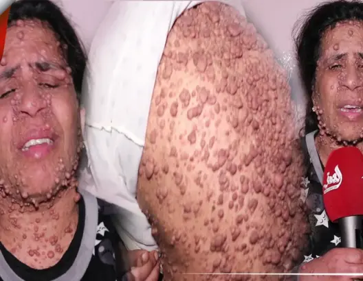 أصابها منذ الصغر.. مرض نادر يحول حياة فاطمة الزهراء من مكناس إلى جحيم (فيديو)