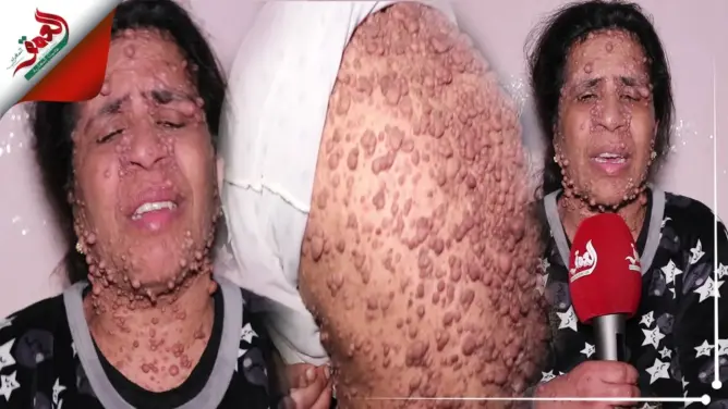 منذ صغرها.. مرض نادر يحول حياة فاطمة الزهراء من مكناس إلى جحيم