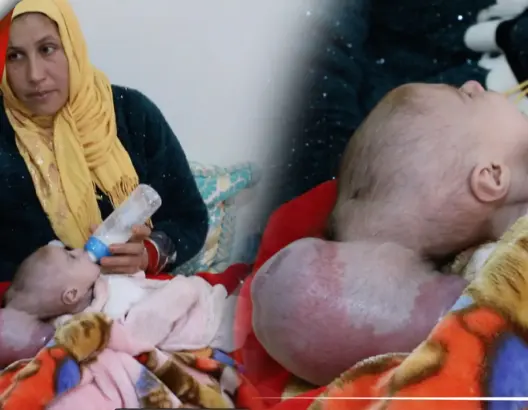 رضيعة تعاني من كتلة ملتصقة برأسها ووالدتها تناشد المحسنين لإجراء عملية مستعجلة (فيديو)
