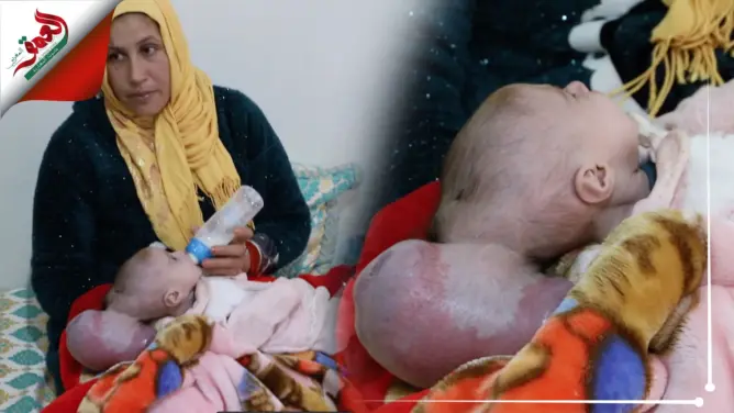 رضيعة تعاني من كتلة ملتصقة برأسها ووالدتها تناشد المحسنين لإجراء عملية مستعجلة (فيديو)