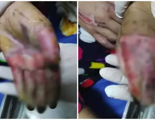 صور صادمة.. سيدة بسطات تُعرِّض طفلة تتكفل بها لحروق خطيرة والأمن يفتح تحقيقا