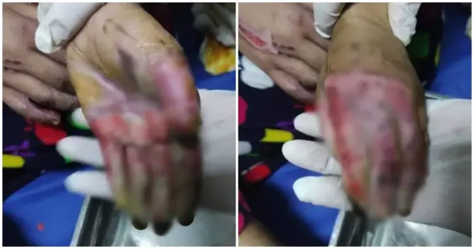 صور صادمة.. سيدة بسطات تُعرِّض طفلة تتكفل بها لحروق خطيرة والأمن يفتح تحقيقا