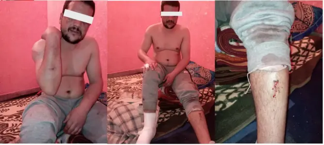 بسبب انتمائه الإيديولوجي.. الاعتداء على طالب بالحي الجامعي بني ملال (صور)