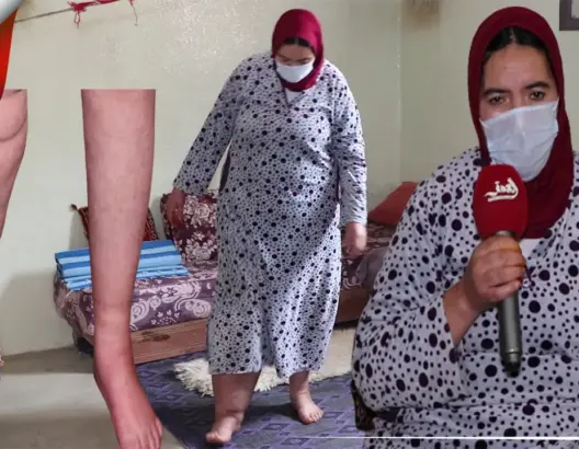 “عيادة”.. سيدة مغربية بعين اللوح تعاني من مرض نادر تناشد المحسنين (فيديو)