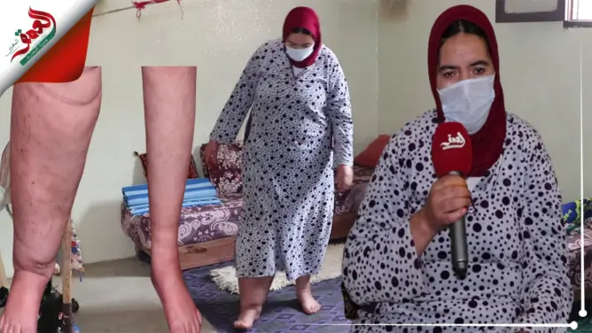 “عيادة”.. سيدة مغربية بعين اللوح تعاني من مرض نادر تناشد المحسنين (فيديو)