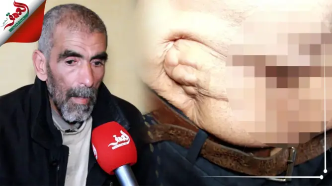لازالت شظاياها في جسمه.. جندي سابق يحكي عن إصابته بقذيفة هاون ويناشد الملك (فيديو)