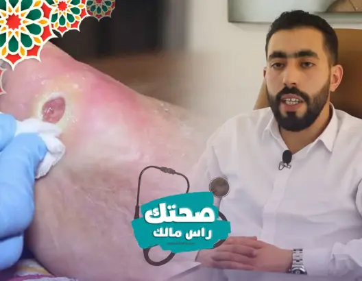 صحتك راس مالك : أسباب ومضاعفات القدم السكري ولماذا يتم بتر القدمين