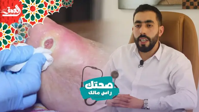 صحتك راس مالك : أسباب ومضاعفات القدم السكري ولماذا يتم بتر القدمين